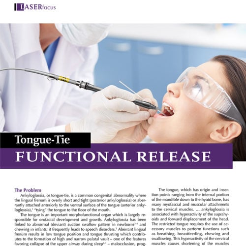 Dental laser tongue tie release
